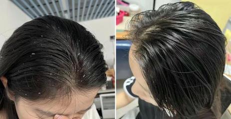 医生建议买的洗发水,医生建议买的洗发水是什么
